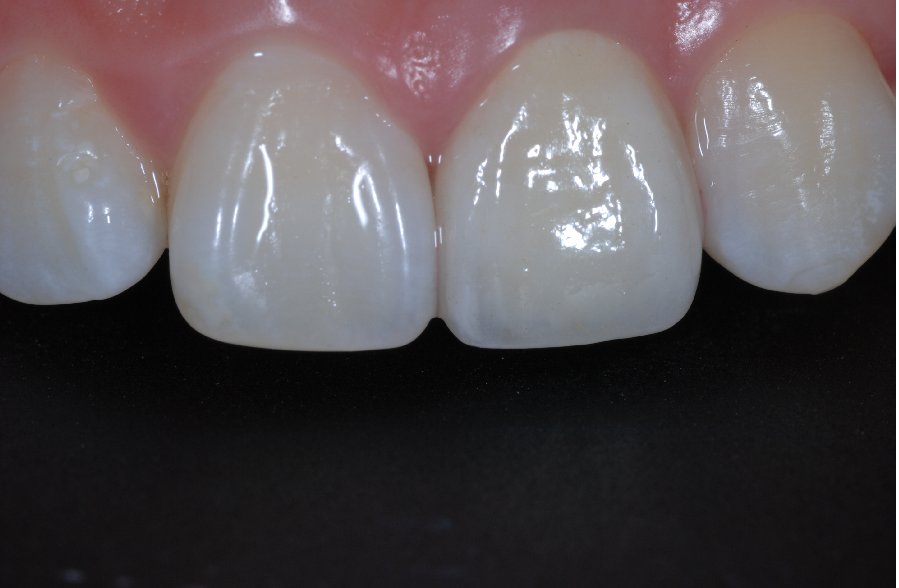 IPS e.max Crown A